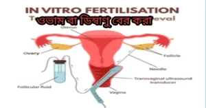 ওভাম বা ডিম্বাণু বের করা