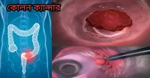 পাদ কোলন ক্যান্সারের লক্ষণ প্রকাশ করে