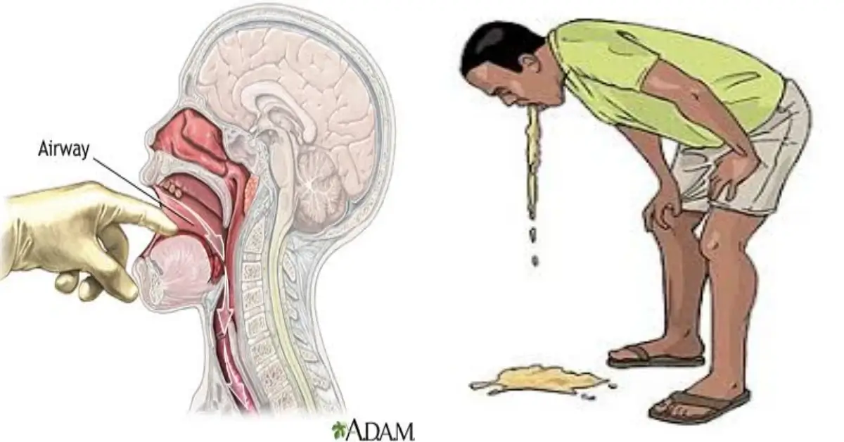 বিষ খাওয়ার প্রাথমিক চিকিৎসা!কেউ বিষ খেলে কি করবেন? বিষ খেলে বমি করানোর পদ্ধতি