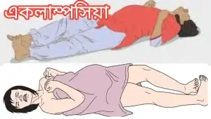 একলাম্পসিয়া কী?একলাম্পসিয়ার কারণ,লক্ষণ ও চিকিৎসা! একলাম্পসিয়া কী?একলাম্পসিয়ার কারণ,লক্ষণ ও চিকিৎসা!গর্ভকালীন খিঁচুনী!