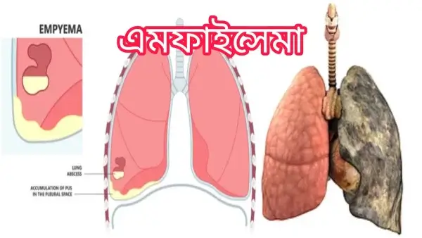 এমফাইসিমা কী? এমফাইসিমার কারণ,লক্ষণ,চিকিৎসা ও প্রতিরোধ! এমফাইসিমা কী? এমফাইসিমার কারণ,লক্ষণ,চিকিৎসা ও প্রতিরোধ!