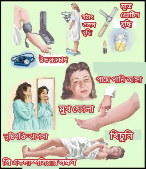 একলাম্পসিয়া কী?একলাম্পসিয়ার কারণ,লক্ষণ ও চিকিৎসা! প্রি একলাম্পসিয়ার লক্ষণ