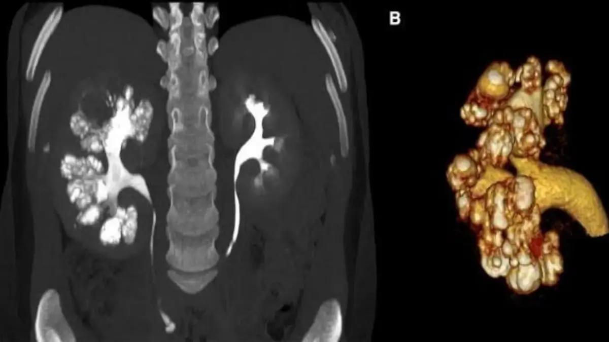 মেডুলারি স্পঞ্জ কিডনি লক্ষণ,চিকিৎসা ও প্রতিরোধ! মেডুলারি স্পঞ্জ কিডনি রোগ নির্ণয়